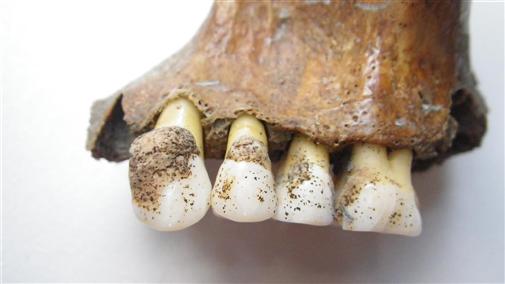 Dental calculus (mineralised plaque) on skeletal remains